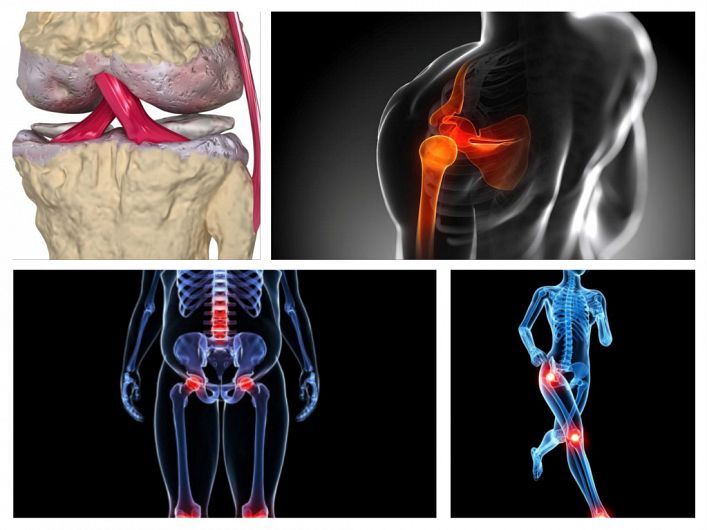 Dureri de spate cu anumite mișcări, Rătăcire dureri articulare în oncologie